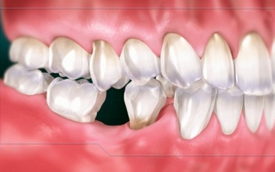 Mất răng số 6 ảnh hưởng như thế nào?