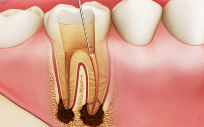 Quy trình chữa tuỷ răng kéo dài bao lâu?