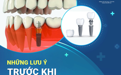 Làm sao để khắc phục sâu răng khi niềng?