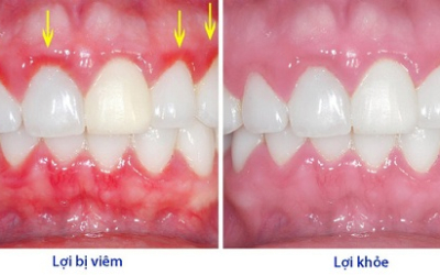 Viêm nha chu nguy hiểm như thế nào?