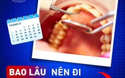 Nên lấy cao răng bao lâu một lần?