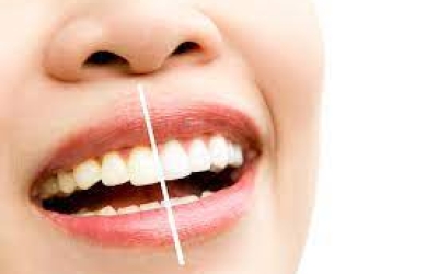 Top 6 phương pháp làm trắng răng hiệu quả