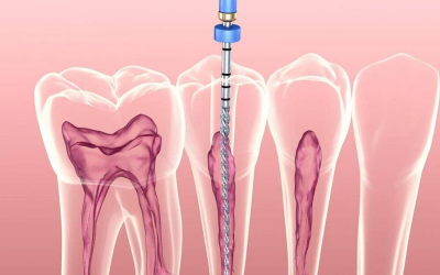 Quy trình điều trị tuỷ răng an toàn