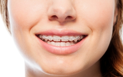 Niềng răng một hàm có được không? Trường hợp nào nên niềng răng một hàm?