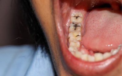Răng hàm bị sâu ở người lớn và cách phòng ngừa