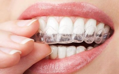 Niềng răng trong suốt invisalign có hiệu quả không?