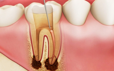 Tìm hiểu về viêm tuỷ răng